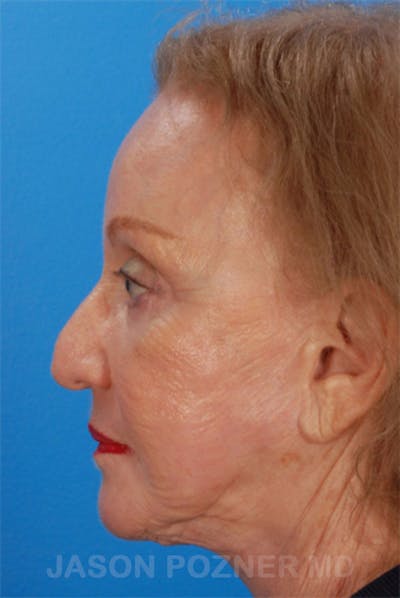Laser Resurfacing Before & After Gallery - Patient 19074403 - Image 6
