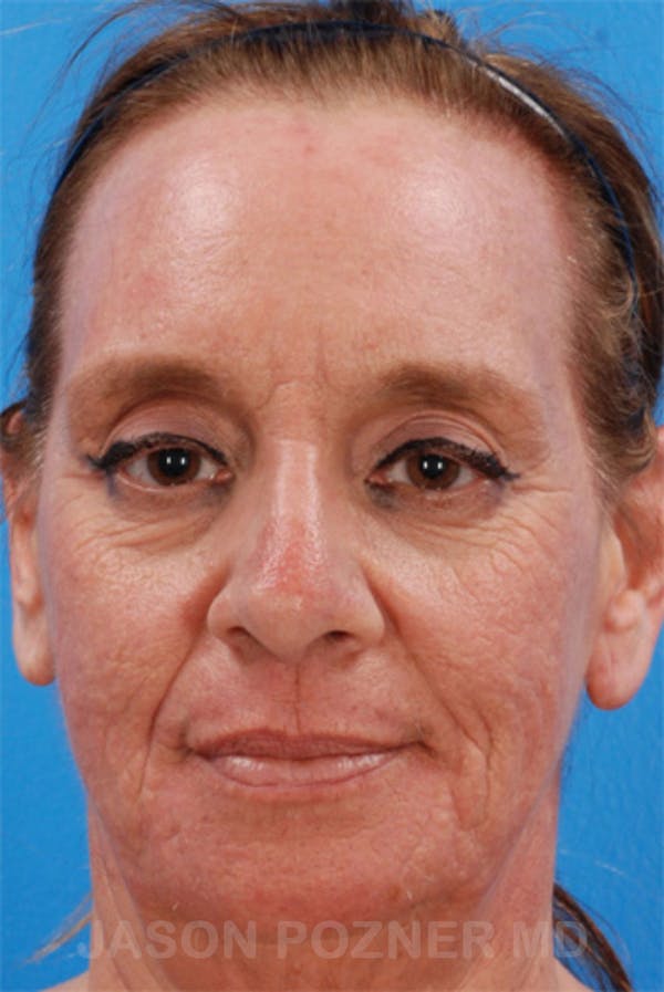 Laser Resurfacing Before & After Gallery - Patient 19074406 - Image 2