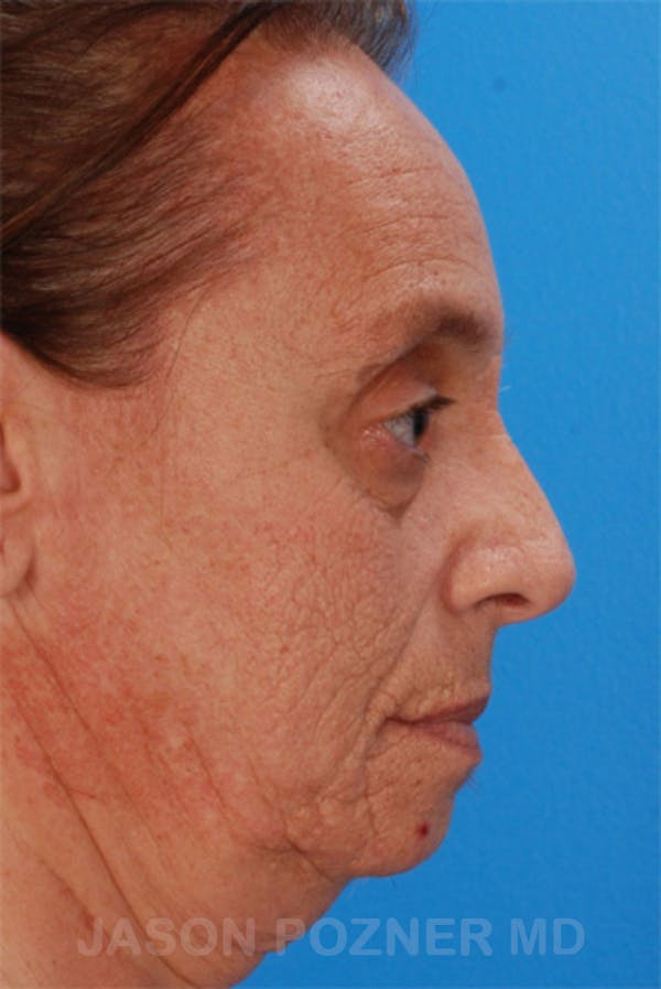 Laser Resurfacing Before & After Gallery - Patient 19074406 - Image 3