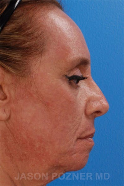 Laser Resurfacing Before & After Gallery - Patient 19074406 - Image 4