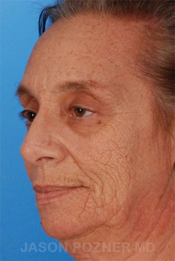 Laser Resurfacing Before & After Gallery - Patient 19074406 - Image 5