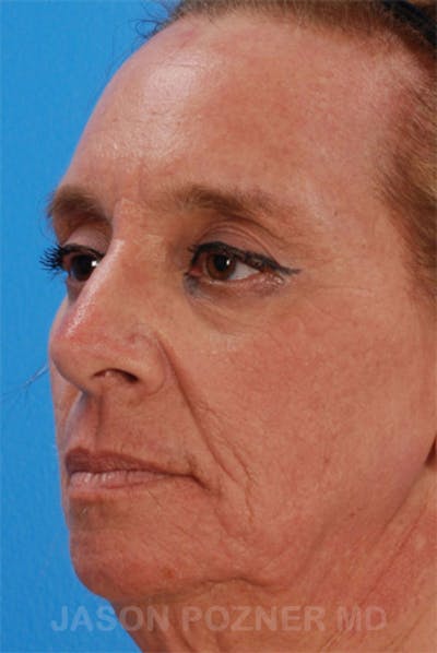 Laser Resurfacing Before & After Gallery - Patient 19074406 - Image 6