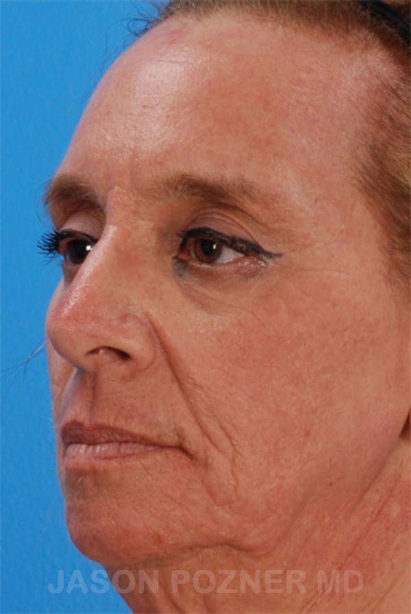 Laser Resurfacing Before & After Gallery - Patient 19074406 - Image 6