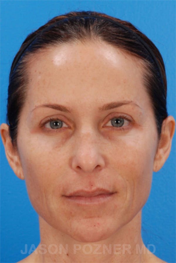 Laser Resurfacing Before & After Gallery - Patient 19074408 - Image 1