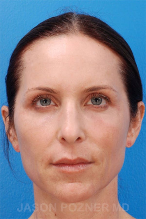 Laser Resurfacing Before & After Gallery - Patient 19074408 - Image 2