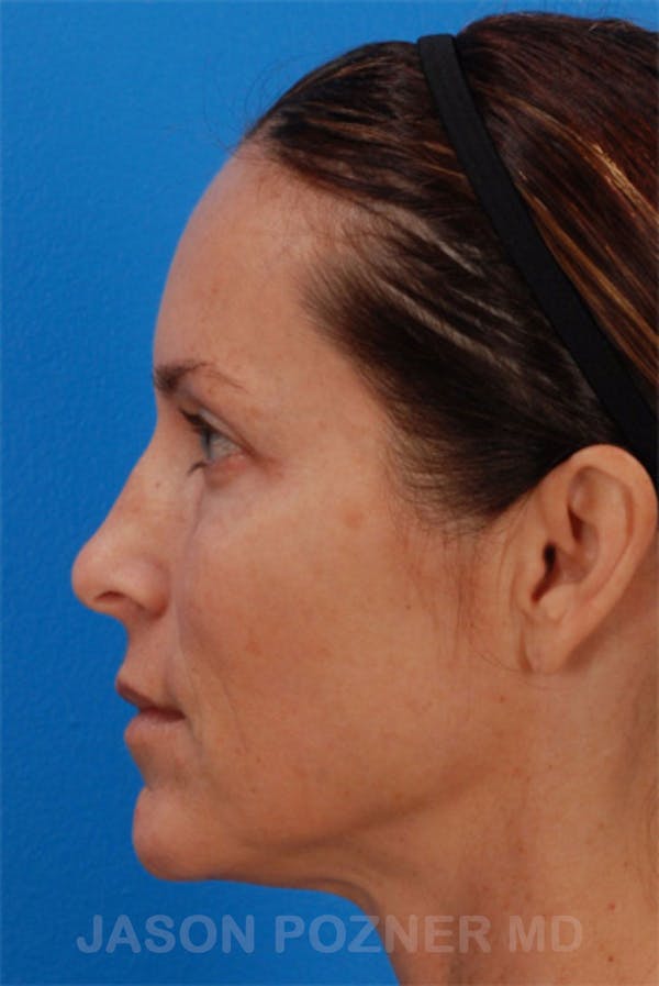 Laser Resurfacing Before & After Gallery - Patient 19074408 - Image 3