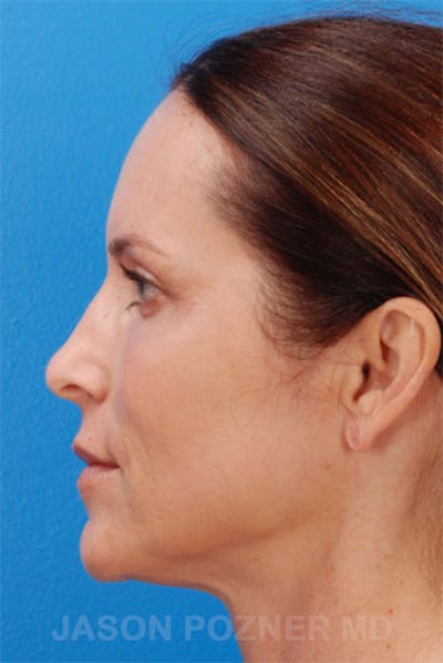 Laser Resurfacing Before & After Gallery - Patient 19074408 - Image 4