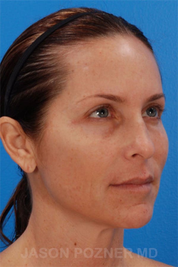 Laser Resurfacing Before & After Gallery - Patient 19074408 - Image 5