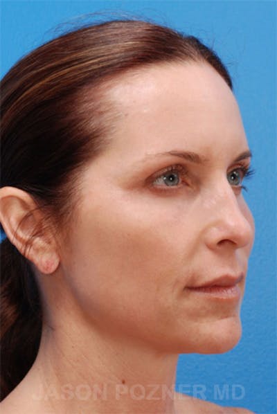 Laser Resurfacing Before & After Gallery - Patient 19074408 - Image 6