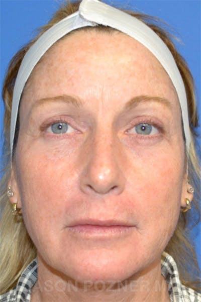 Laser Resurfacing Before & After Gallery - Patient 19074409 - Image 1