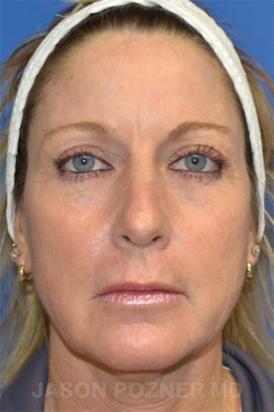 Laser Resurfacing Before & After Gallery - Patient 19074409 - Image 2