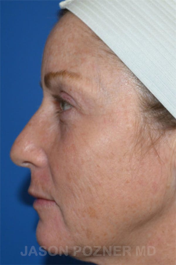 Laser Resurfacing Before & After Gallery - Patient 19074409 - Image 3