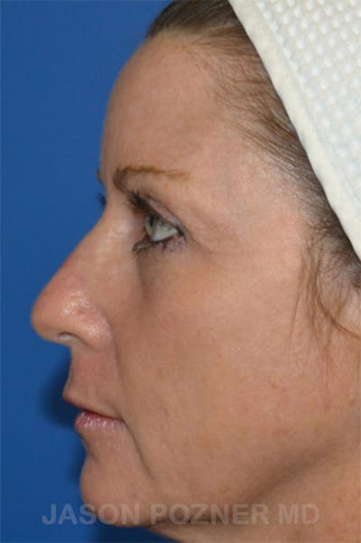 Laser Resurfacing Before & After Gallery - Patient 19074409 - Image 4