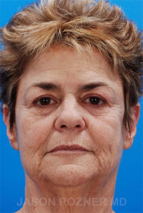 Laser Resurfacing Before & After Gallery - Patient 19074411 - Image 1