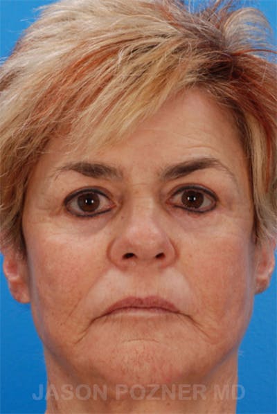 Laser Resurfacing Before & After Gallery - Patient 19074411 - Image 2