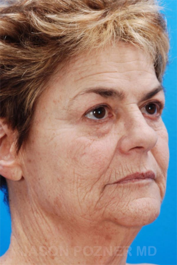 Laser Resurfacing Before & After Gallery - Patient 19074411 - Image 3