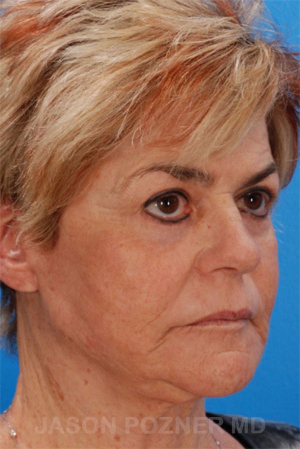 Laser Resurfacing Before & After Gallery - Patient 19074411 - Image 4