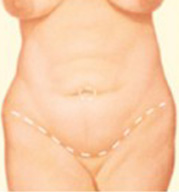 Tummy Tuck Step 1 image