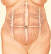 Tummy Tuck Step 2 image