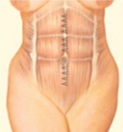 Tummy Tuck Step 3 image