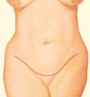 Tummy Tuck Step 4 image