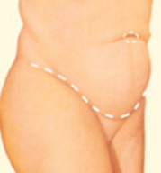 Tummy Tuck Step 5 image