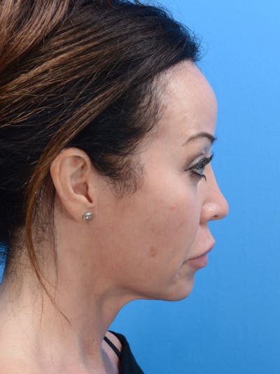 MOXI™ Laser Before & After Gallery - Patient 23532742 - Image 1