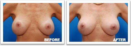 before and after picture