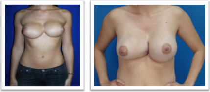 picture of breasts