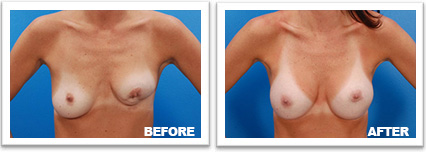 picture of breasts