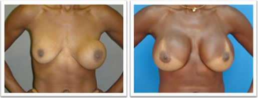 picture of breasts