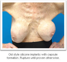 picture of breasts