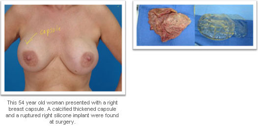 picture of breasts