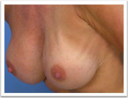 picture of breasts