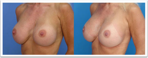 picture of breasts