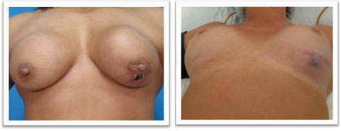 picture of breasts