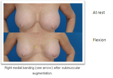 picture of breasts
