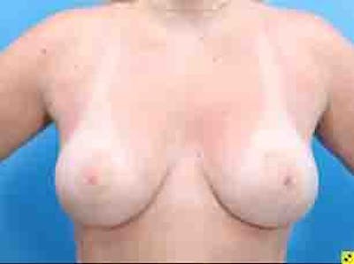 Breast Lift Before & After Gallery - Patient 36601569 - Image 1