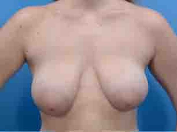 Breast Lift Gallery - Patient 36601569 - Image 2