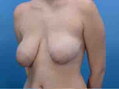 Breast Lift Before & After Gallery - Patient 36601569 - Image 4