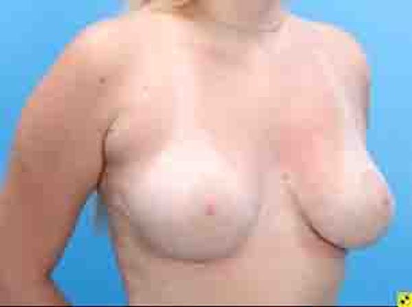 Breast Lift Gallery - Patient 36601569 - Image 7