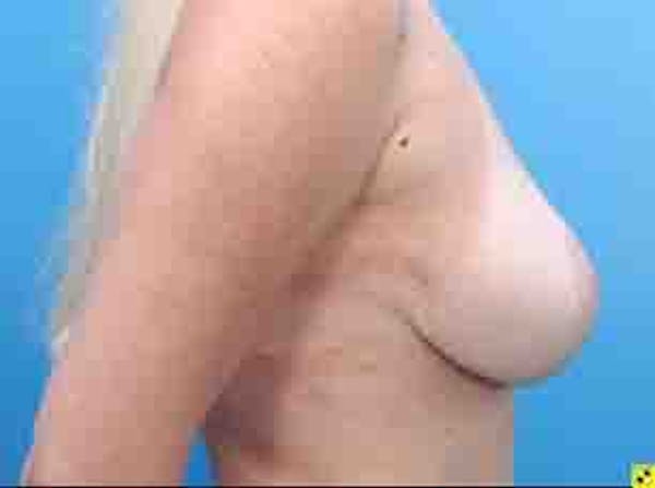 Breast Lift Before & After Gallery - Patient 36601569 - Image 9