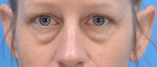 Blepharoplasty Before & After Gallery - Patient 42556541 - Image 1