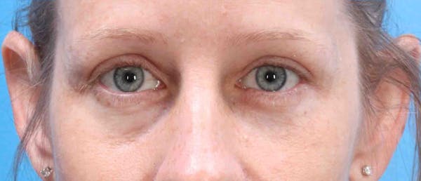 Blepharoplasty Before & After Gallery - Patient 42556541 - Image 2