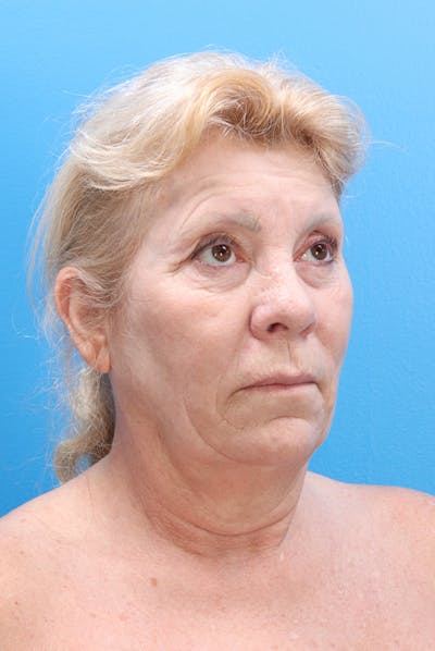 Facelift Before & After Gallery - Patient 61120662 - Image 1