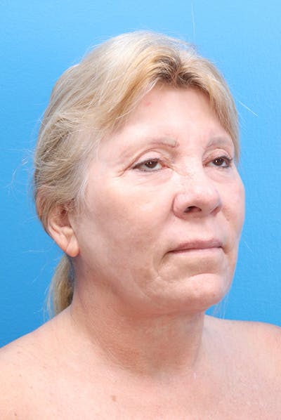 Facelift Before & After Gallery - Patient 61120662 - Image 2