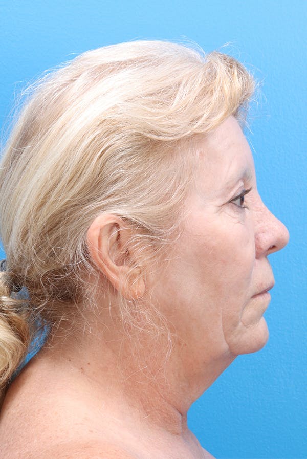 Facelift Before & After Gallery - Patient 61120662 - Image 3