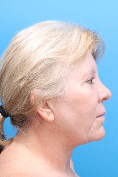 Facelift Before & After Gallery - Patient 61120662 - Image 4