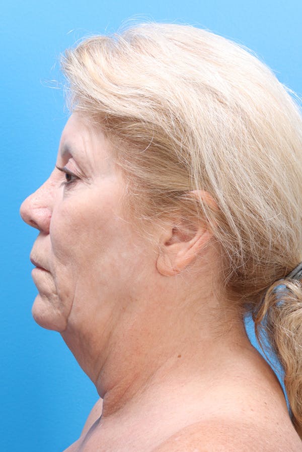 Facelift Before & After Gallery - Patient 61120662 - Image 5