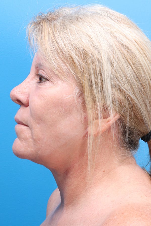 Facelift Before & After Gallery - Patient 61120662 - Image 6